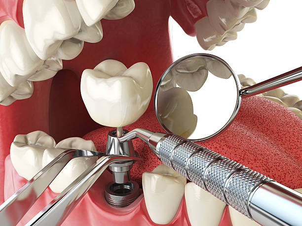 Best Emergency Dental Care for Sports Injuries in Rice, MN