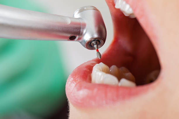Best Emergency Root Canal Therapy in Rice, MN